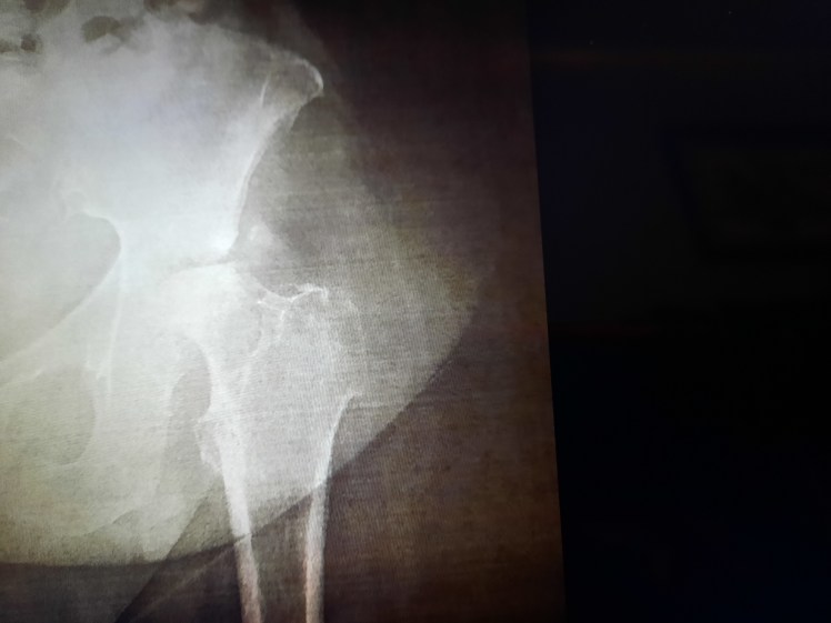 Left Femur head erosion